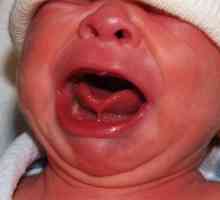 Kratki frenum jezika pri novorojenčku