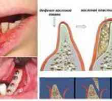 Plastičnost kosti za implantacijo zob: opis in cena