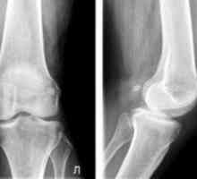 Zdravljenje artroze kolenskega sklepa 1 stopinja