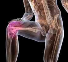 Zdravljenje artroze kolenskega sklepa doma
