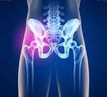 Zdravljenje artroze kolčnega sklepa