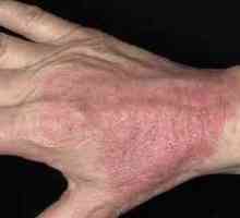 Zdravljenje atopičnega dermatitisa pri odraslih