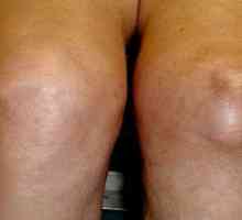 Zdravljenje bursitisa kolenskega sklepa doma