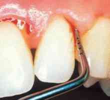 Obdelava gum v zobozdravstvu in morebitne bolezni