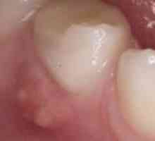 Zdravljenje fluks na dlesni doma