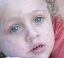 Zdravljenje herpesa pri otrocih, fotografija zunanjih manifestacij patologije
