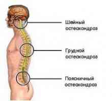 Zdravljenje in simptomi osteohondroze prsne hrbtenice