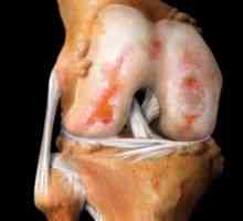 Zdravljenje kolenskih sklepov iz gonartroze