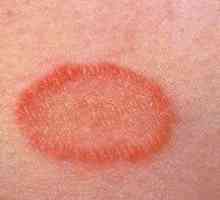 Zdravljenje roza lišajev pri ljudeh: simptomi, fotografije