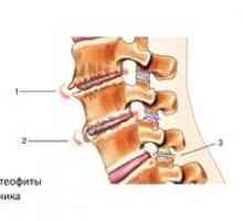 Zdravljenje hrbtenice na hrbtenici in simptomi osteofitov