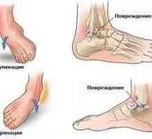 Zdravljenje doma z vdolbinico stopala