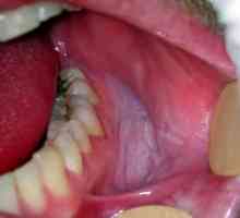 Zdravljenje bolezni ustne sluznice