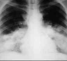 Legionelozna pljučnica. Legioneloza ali Legionirjeva bolezen