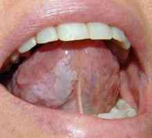Leukoplakija ustne sluznice: zdravljenje