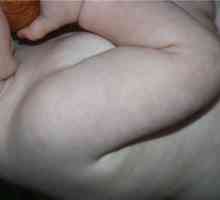 Mramorna koža pri dojenčkih: vzroki in metode zdravljenja