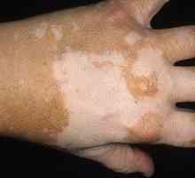 Začetna stopnja vitiliga pri otrocih