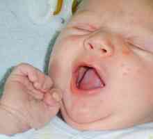 Kako nevarne so akne na obrazu novorojenčka?