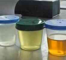 Nenavadna barva urina - kaj pravi