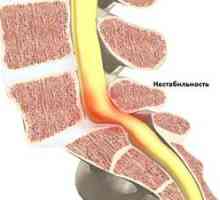 Nestabilnost vratne hrbtenice: zdravljenje in simptomi