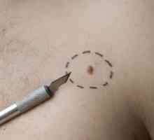 Neoplazme na koži: fotografije, vrste in metode zdravljenja