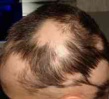 Alopecia areata (plešavost): manifestacije bolezni in zdravljenje