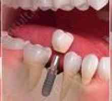 Takojšnja implantacija zob: cene in opis metode