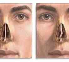 Delovanje pri ukrivljenosti nosnega septuma in diagnostika odstopanja