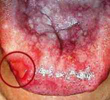 Opis in zdravljenje rdečih ploskih lišajev v ustni votlini