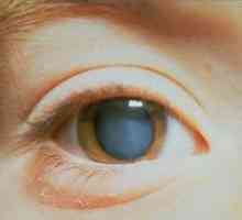 Zapletena očesna obema očesoma: kakšna je ta patologija?