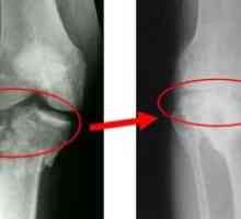 Glavne metode zdravljenja gonartroze kolenskega sklepa tretje stopnje