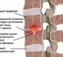 Značilnosti kile, shmorlya in načela zdravljenja hrbtenice