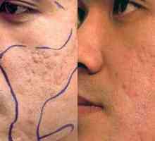 Značilnosti laserske in mehanske dermabrazije obraza