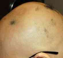 Značilnosti razvoja in zdravljenja celotne alopecije pri ženskah