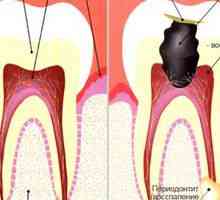 Akutni periodontitis: vzroki, simptomi in zdravljenje