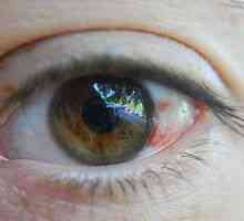 Kaj lahko razbije krvne žile v očeh?