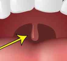 Otekanje palatina v grlu in iz katerega se lahko poveča
