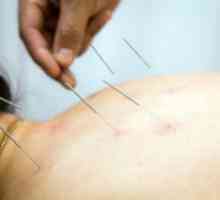 Mnenja o akupunkturi za osteohondrozo v materničnem oddelku