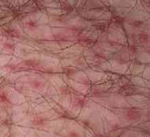 Inguinalni dermatitis pri moških: diagnosticiranje in zdravljenje