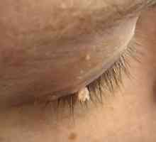 Papillomi na obrazu: značilnosti zdravljenja in fotografije