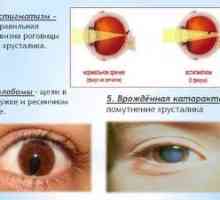 Patologija slabega vida pri otrocih: astigmatizem, kaj je to?