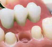 Plastične krone na sprednjih zobeh
