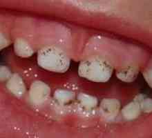 Zakaj se na zobah pojavijo črne pike in kako se lahko zdravijo?