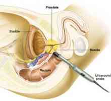 Priprava na hipertiroidizem prostate in kako analizirati