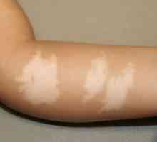 Pojav belih madežev na koži otroka: anamneza in posledice