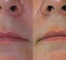 Indikacije in kontraindikacije za lasersko epilacijo zgornje ustnice