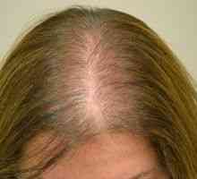 Vzroki in zdravljenje alopecije pri ženskah