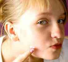 Vzroki in zdravljenje aken na obrazih žensk