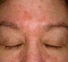 Vzroki in zdravljenje seborejskega dermatitisa na obrazu