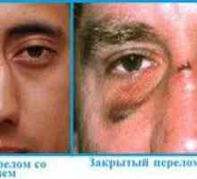 Vzroki in simptomi zlomljenega nosu
