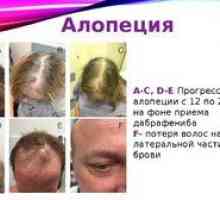 Vzroki alopecije (alopecija) in zdravljenja